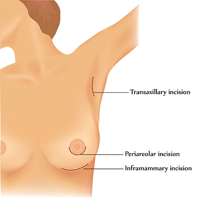 aumento mamario via axilar