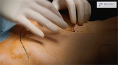 ambos procedimientos |&nbsp;Diferencias entre abdominoplastia y miniabdominoplastia