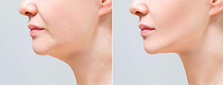 resultados naturales para lucir un rostro rejuvenecido |&nbsp;liposuccion de papada