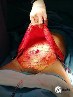abdominoplastia piel levantada