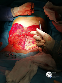 abdominoplastia | plicatura abdominal